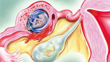 Gravidanza extrauterina